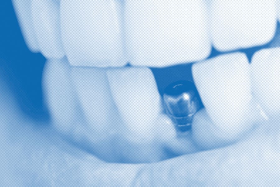 Quali Sono I Vantaggi Degli Impianti Dentali? • Gengive.org