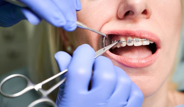 denti storti parodontite