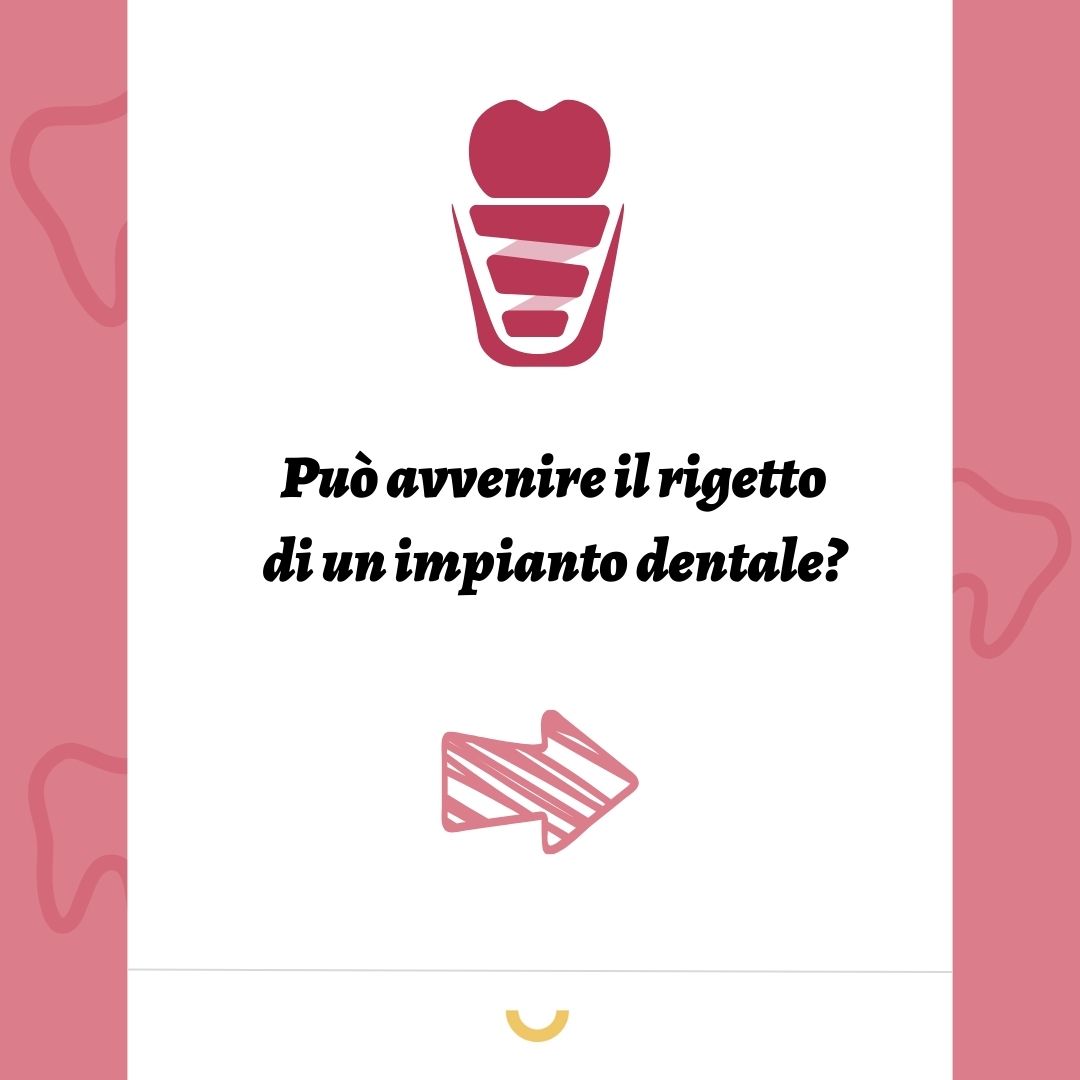 Può avvenire il rigetto di un impianto dentale?